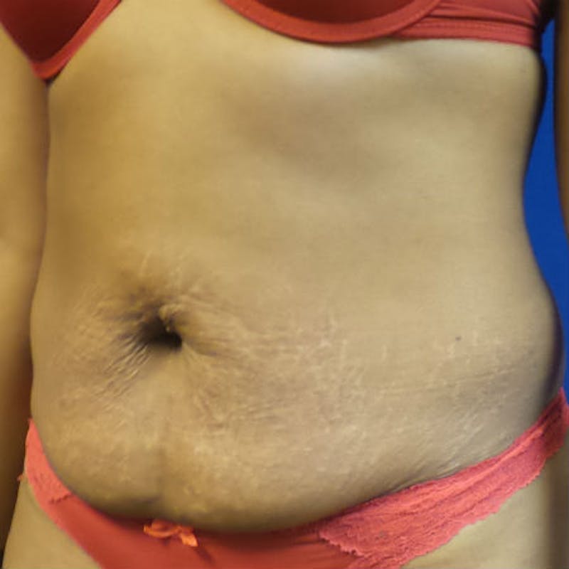 Abdominoplasty Before & After Gallery - Patient 154949070 - Image 3