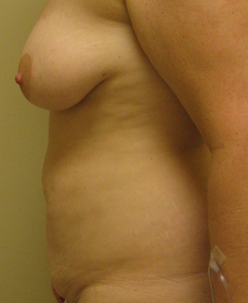Mommy Makeover Before & After Gallery - Patient 154949067 - Image 5