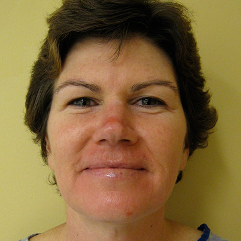 Facial Rejuvenation Before & After Gallery - Patient 154949074 - Image 1