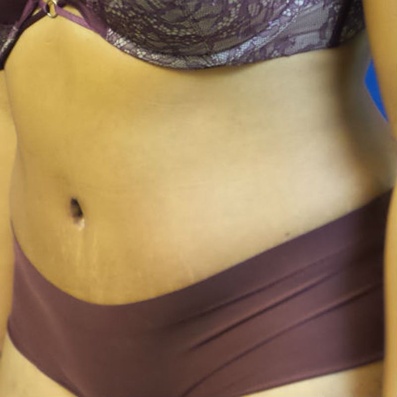 Abdominoplasty Before & After Gallery - Patient 154949070 - Image 4
