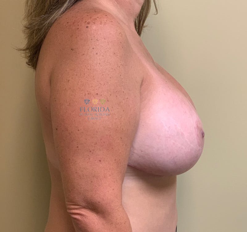 Augmentation Mastopexy Before & After Gallery - Patient 154949066 - Image 6