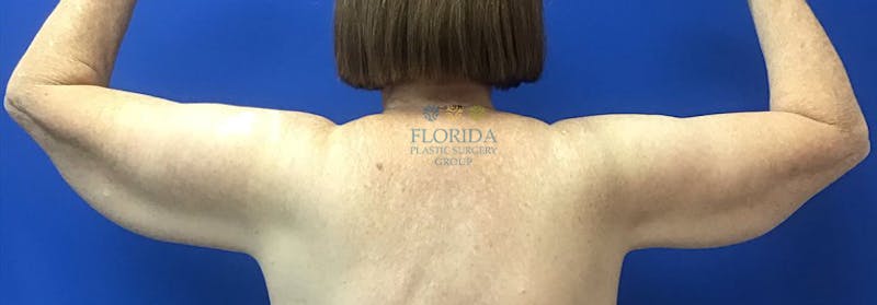 Arm Lift Before & After Gallery - Patient 154949072 - Image 3