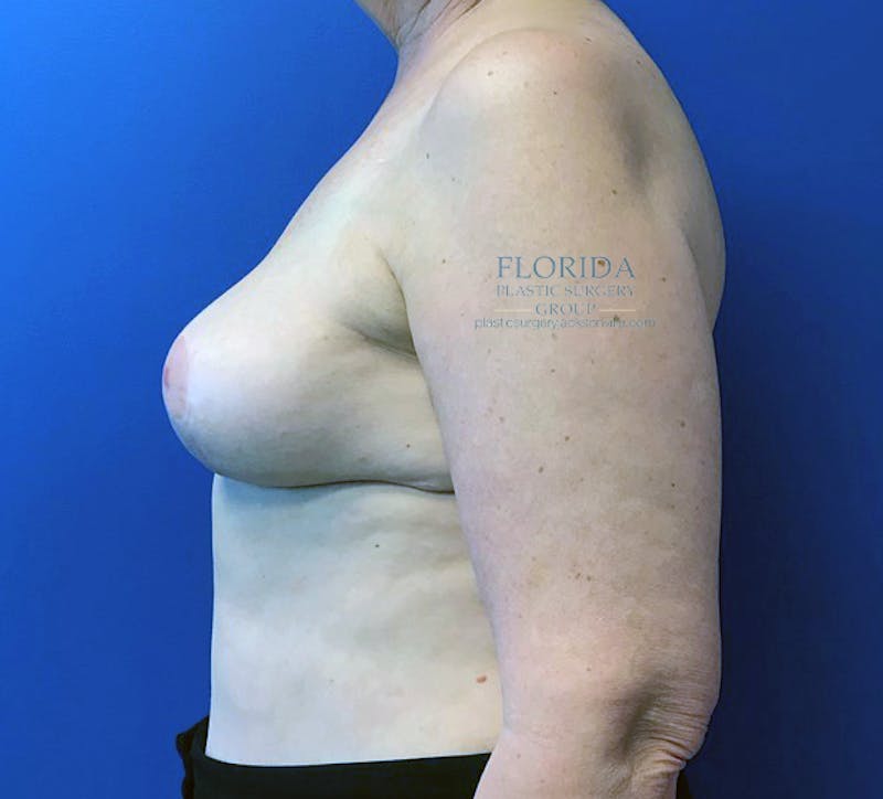 DIEP Flap Reconstruction Before & After Gallery - Patient 154949068 - Image 6
