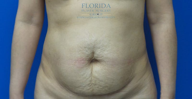 Abdominoplasty Before & After Gallery - Patient 154949083 - Image 1