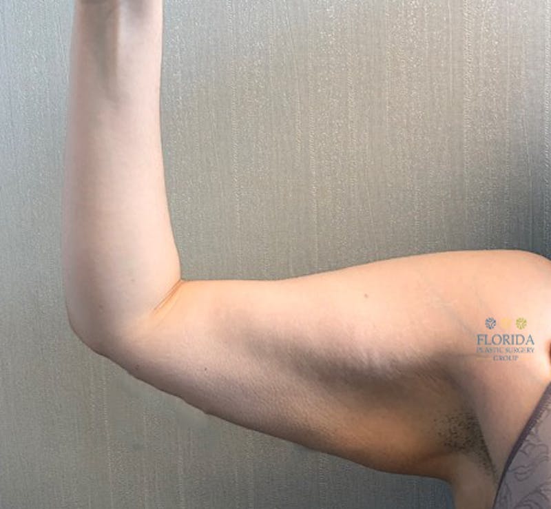 Arm Lift Before & After Gallery - Patient 154949080 - Image 1