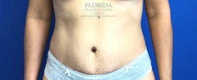 Abdominoplasty Before & After Gallery - Patient 154949083 - Image 2