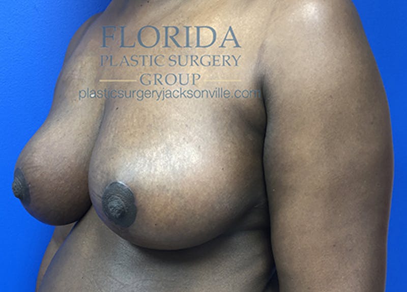 Breast Reduction Before & After Gallery - Patient 154949089 - Image 4