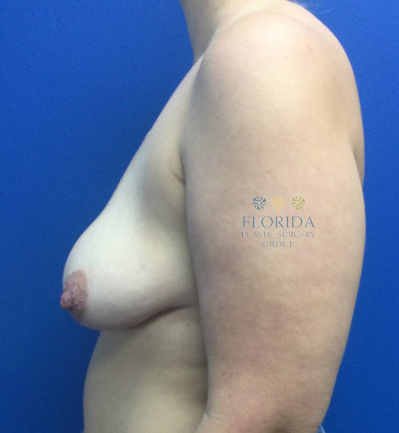 Augmentation Mastopexy Before & After Gallery - Patient 154949078 - Image 3