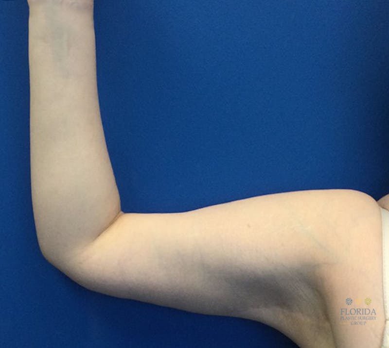 Arm Lift Before & After Gallery - Patient 154949080 - Image 2