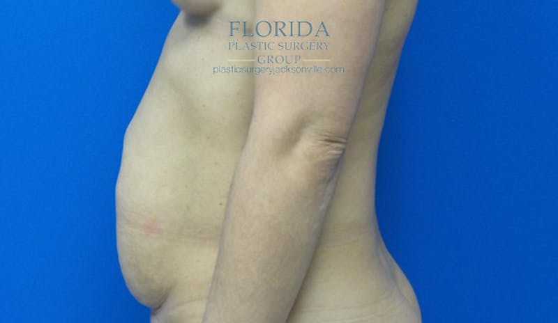 Abdominoplasty Before & After Gallery - Patient 154949083 - Image 3