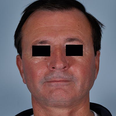 Facial Rejuvenation Before & After Gallery - Patient 154949081 - Image 2