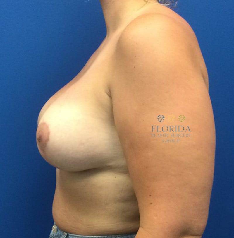 Augmentation Mastopexy Before & After Gallery - Patient 154949078 - Image 4