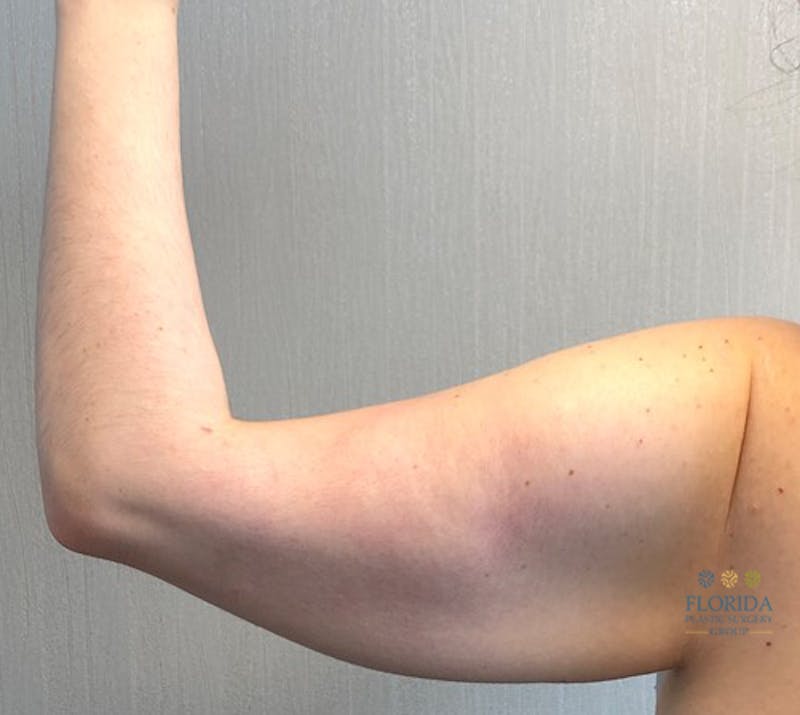 Arm Lift Before & After Gallery - Patient 154949080 - Image 3