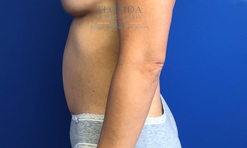 Abdominoplasty Before & After Gallery - Patient 154949083 - Image 4