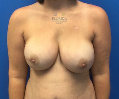 Nipple Sparing Breast Reconstruction Before & After Gallery - Patient 154949091 - Image 2