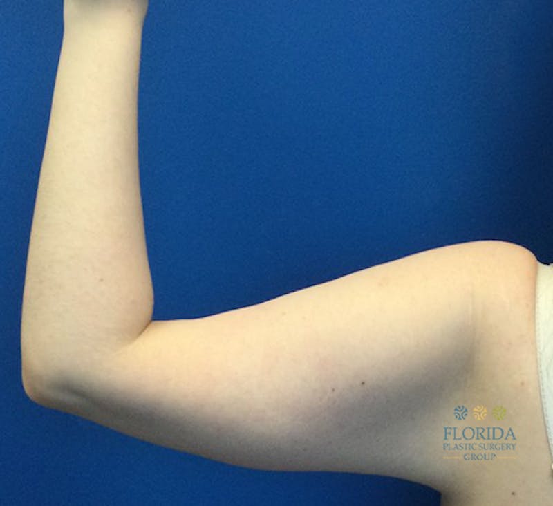 Arm Lift Before & After Gallery - Patient 154949080 - Image 4