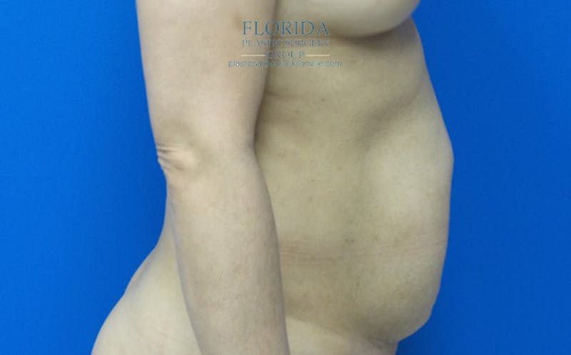 Abdominoplasty Before & After Gallery - Patient 154949083 - Image 5