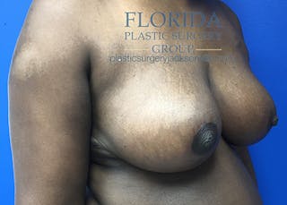 Breast Reduction Before & After Gallery - Patient 154949089 - Image 8