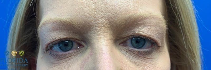 Blepharoplasty Before & After Gallery - Patient 154949097 - Image 1