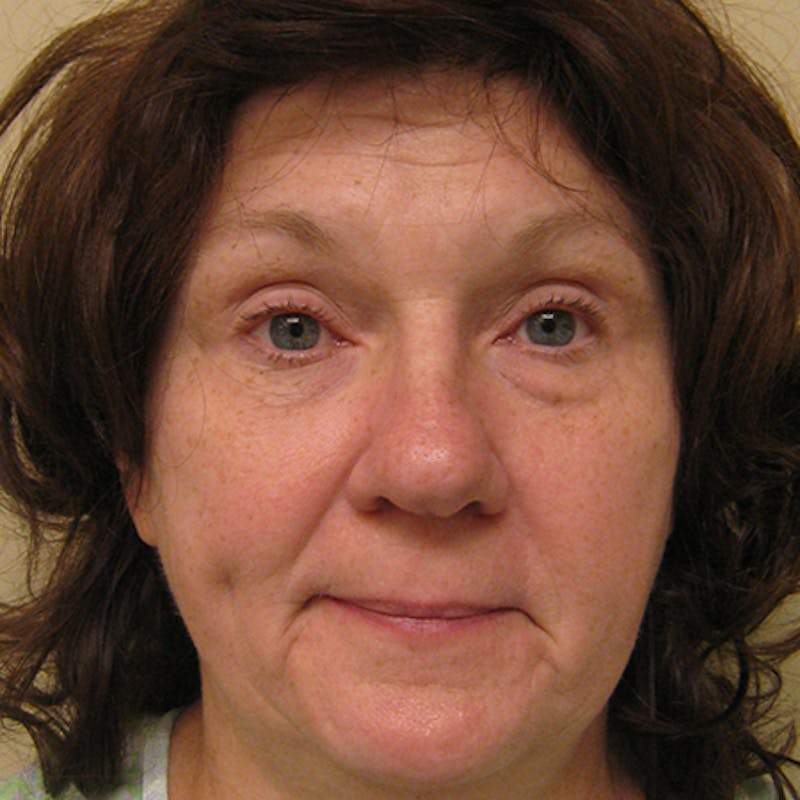 Facial Rejuvenation Before & After Gallery - Patient 154949096 - Image 1