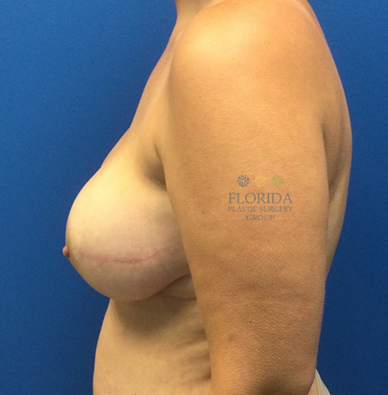 Nipple Sparing Breast Reconstruction Before & After Gallery - Patient 154949091 - Image 4