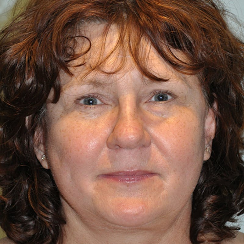 Facial Rejuvenation Before & After Gallery - Patient 154949096 - Image 2