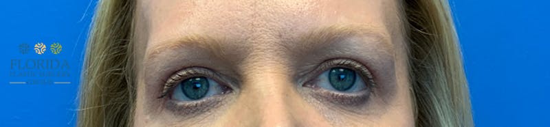 Blepharoplasty Before & After Gallery - Patient 154949097 - Image 2