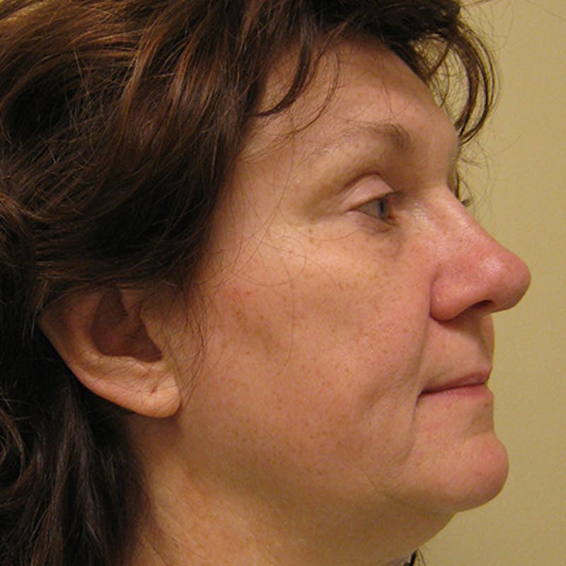 Facial Rejuvenation Before & After Gallery - Patient 154949096 - Image 3
