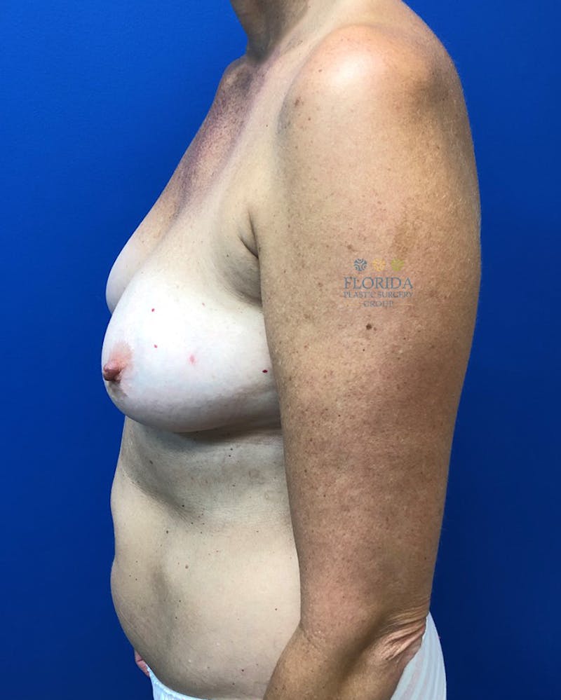 DIEP Flap Reconstruction Before & After Gallery - Patient 154949093 - Image 5