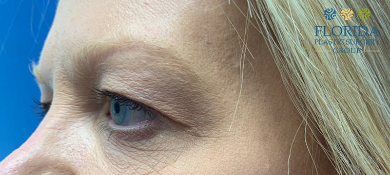 Blepharoplasty Before & After Gallery - Patient 154949097 - Image 3