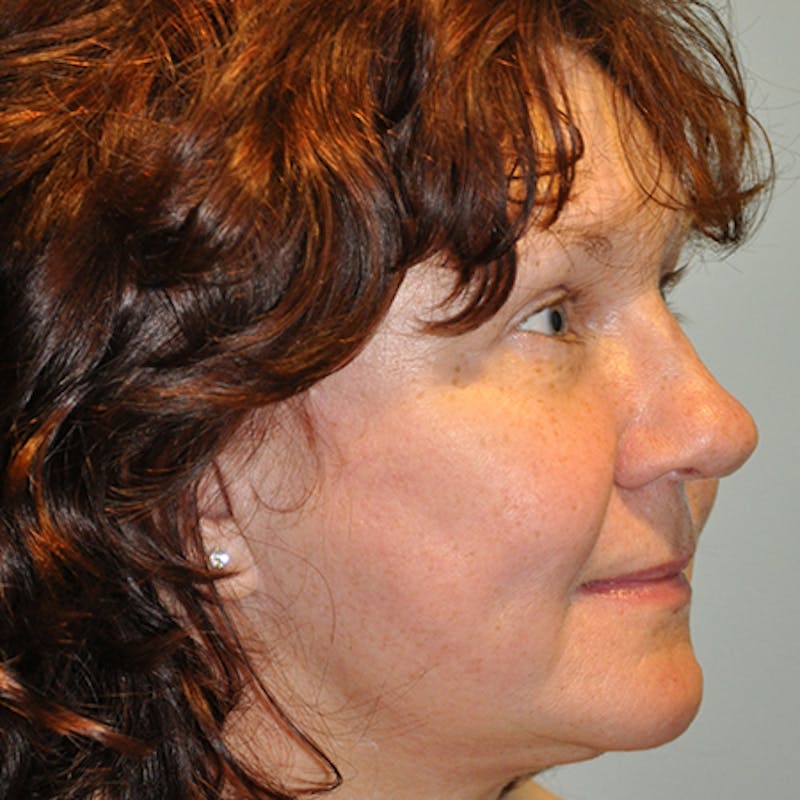 Facial Rejuvenation Before & After Gallery - Patient 154949096 - Image 4