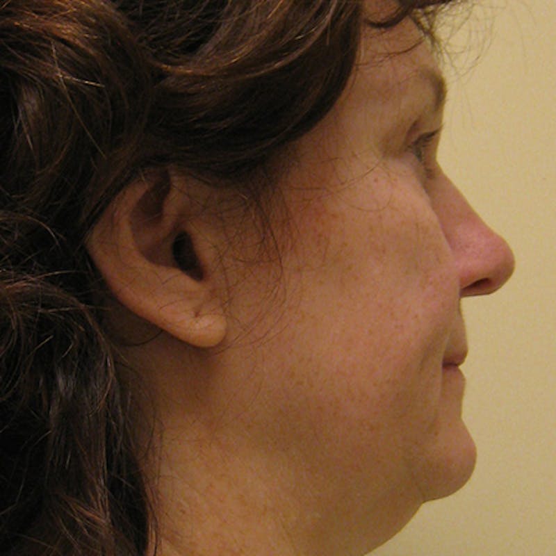 Facial Rejuvenation Before & After Gallery - Patient 154949096 - Image 5