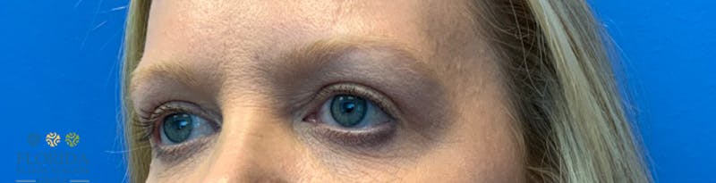 Blepharoplasty Before & After Gallery - Patient 154949097 - Image 4