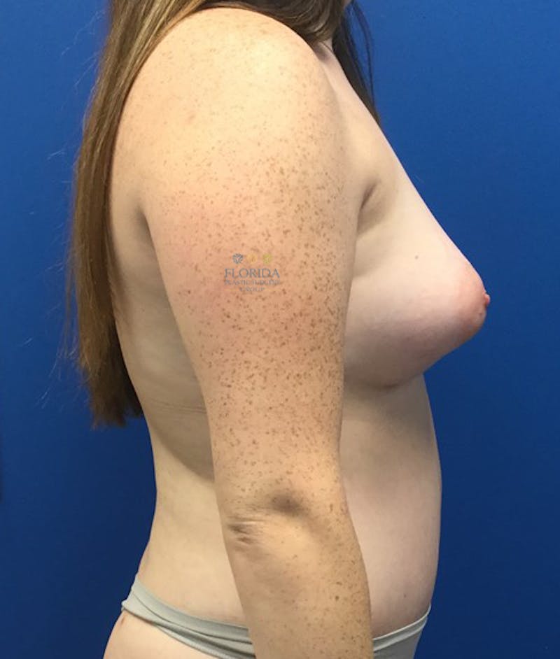 Abdominoplasty Before & After Gallery - Patient 154949101 - Image 4