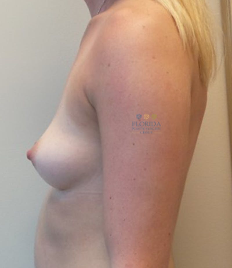 Silicone Breast Augmentation Before & After Gallery - Patient 154949094 - Image 5