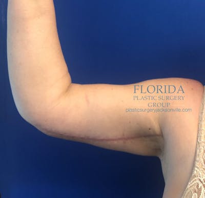 Arm Lift Before & After Gallery - Patient 154949098 - Image 2