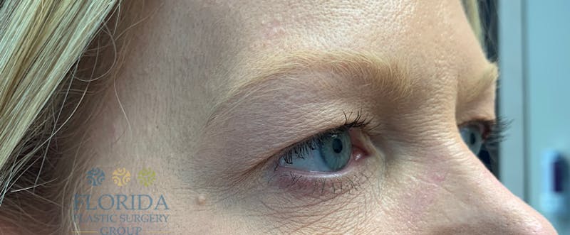 Blepharoplasty Before & After Gallery - Patient 154949097 - Image 5
