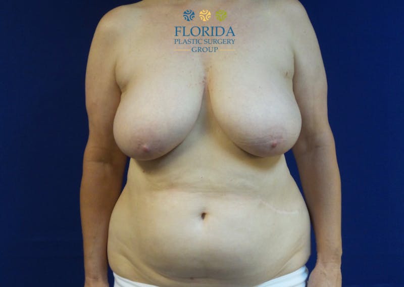 DIEP Flap Reconstruction Before & After Gallery - Patient 154949107 - Image 1