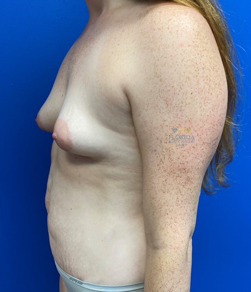 Abdominoplasty Before & After Gallery - Patient 154949101 - Image 5