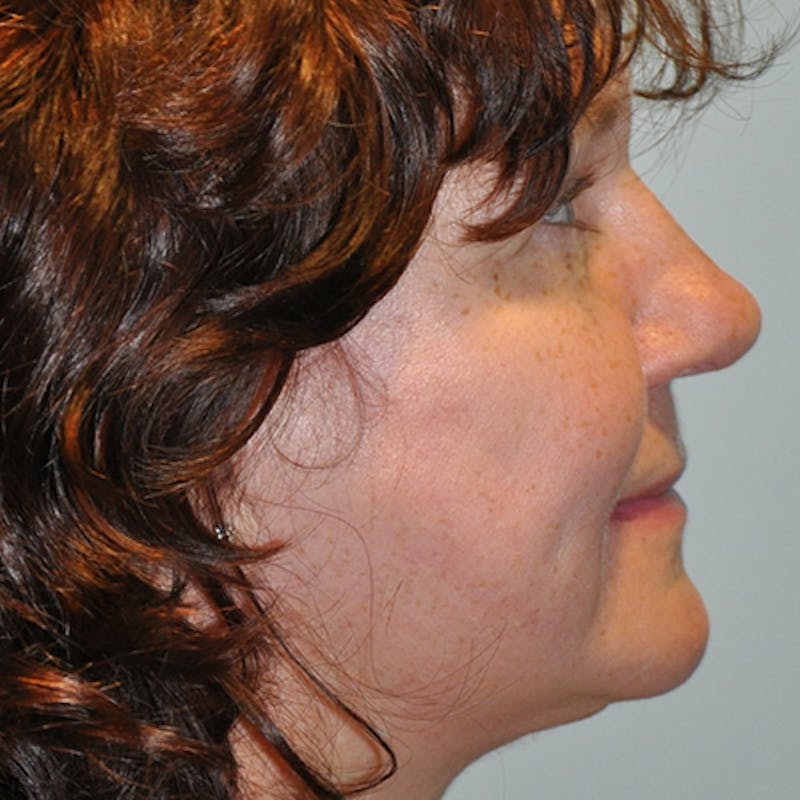 Facial Rejuvenation Before & After Gallery - Patient 154949096 - Image 6