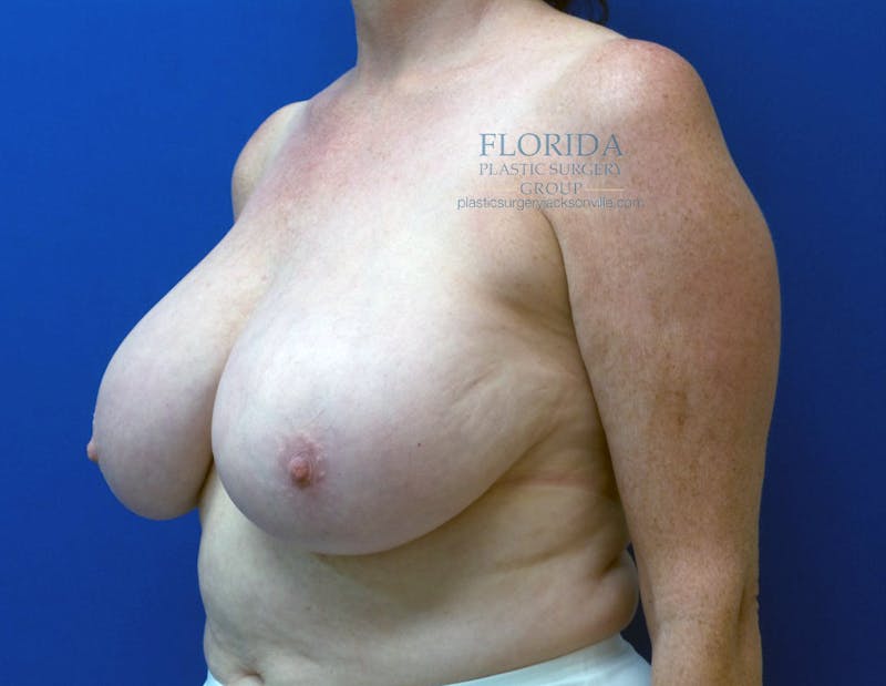 Breast Reduction Before & After Gallery - Patient 154949105 - Image 3