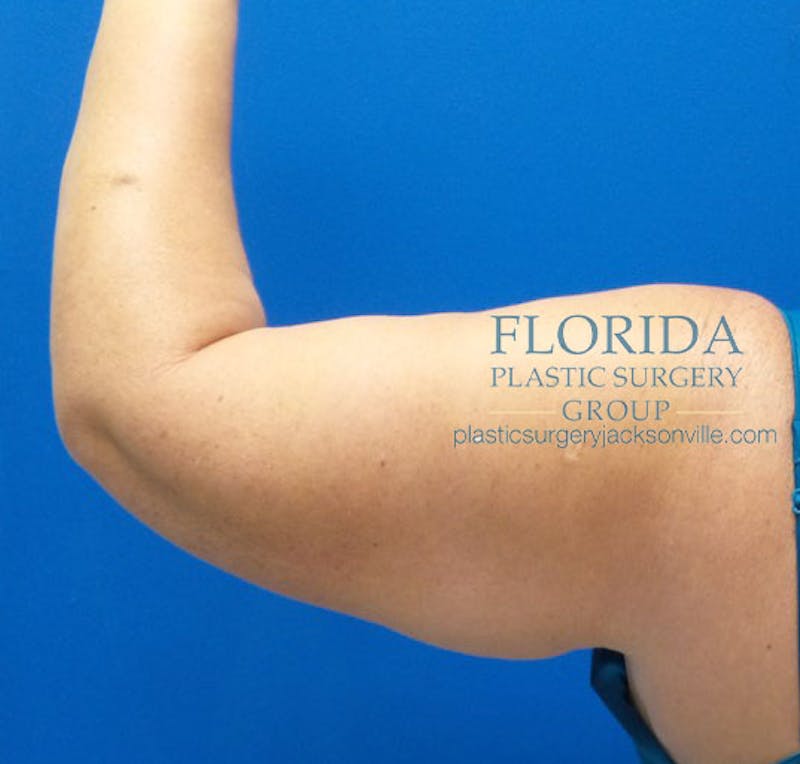 Arm Lift Before & After Gallery - Patient 154949098 - Image 3
