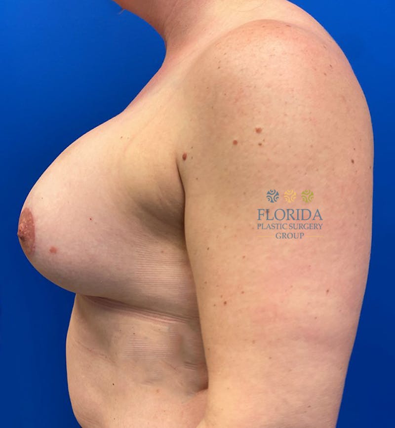 Augmentation Mastopexy Before & After Gallery - Patient 154949102 - Image 4