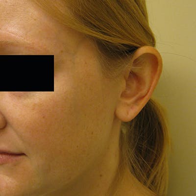 Otoplasty Before & After Gallery - Patient 154949108 - Image 1
