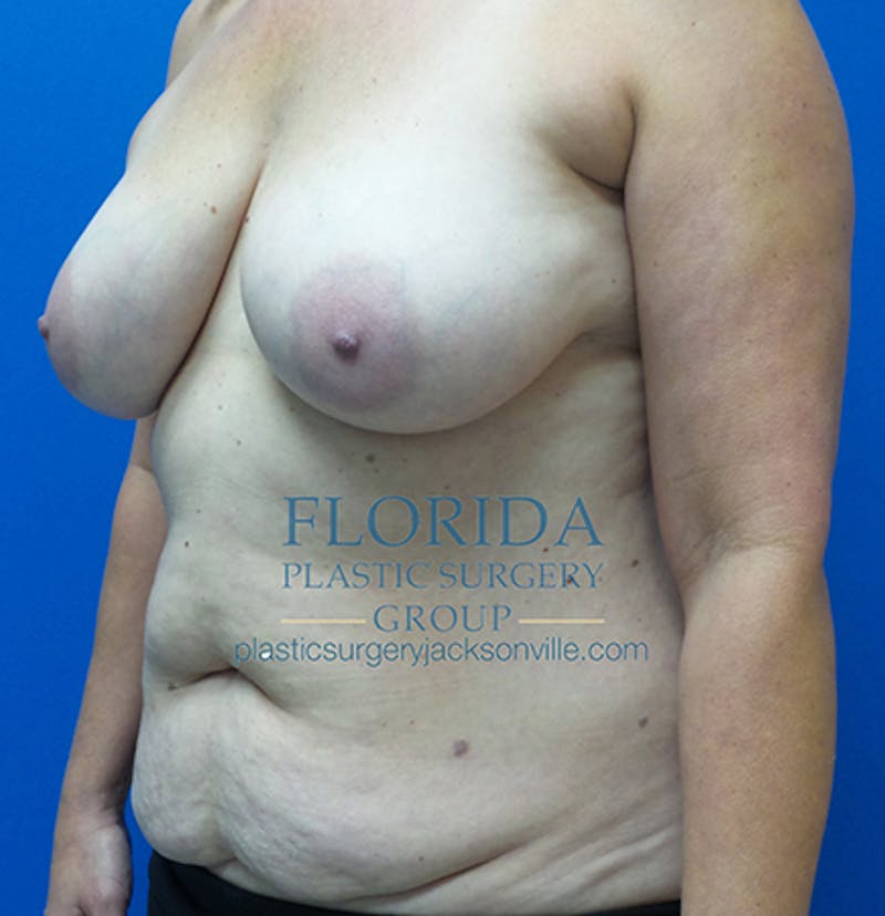 Mommy Makeover Before & After Gallery - Patient 154949104 - Image 7