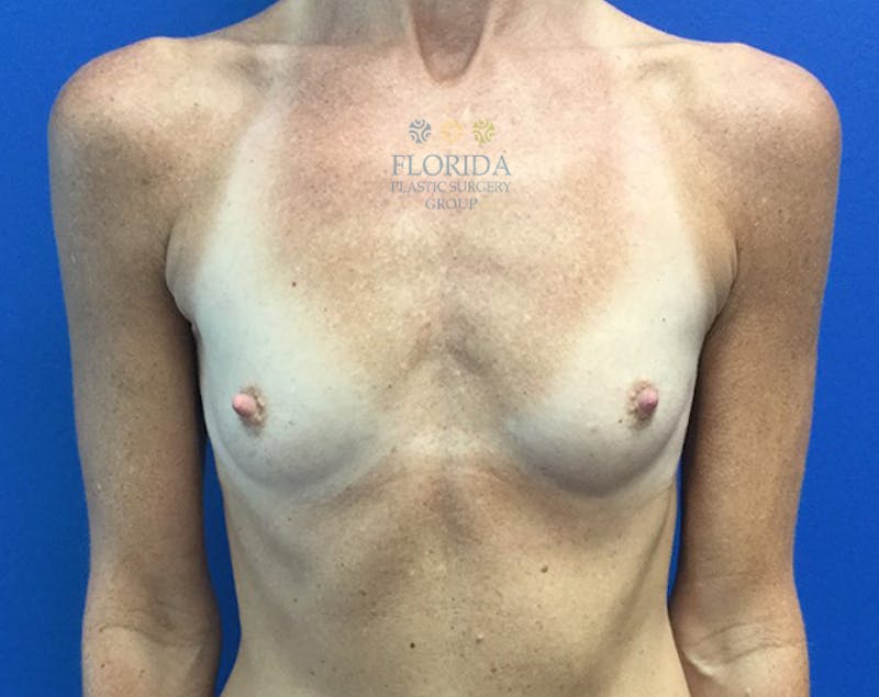 Silicone Breast Augmentation Before & After Gallery - Patient 154949116 - Image 1