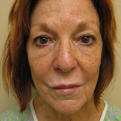 Facial Rejuvenation Before & After Gallery - Patient 154949106 - Image 1