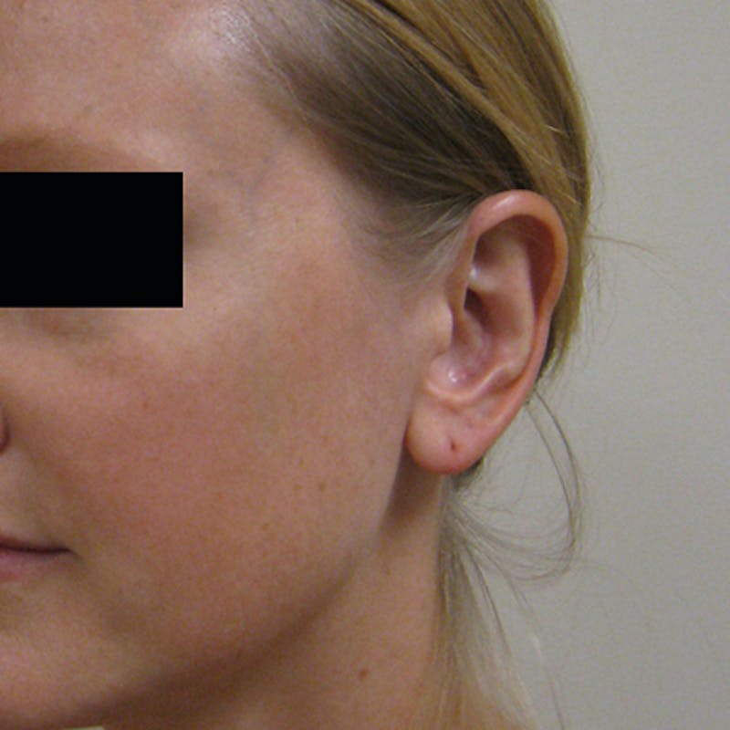 Otoplasty Before & After Gallery - Patient 154949108 - Image 2