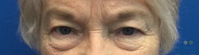 Blepharoplasty Before & After Gallery - Patient 154949112 - Image 1
