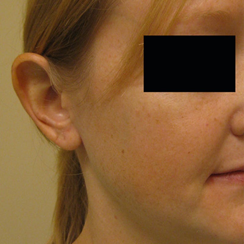 Otoplasty Before & After Gallery - Patient 154949108 - Image 3